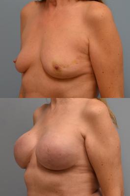 BREAST RECONSTRUCTION WITH TISSUE EXPANDERS 