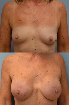 BREAST RECONSTRUCTION WITH TISSUE EXPANDERS 