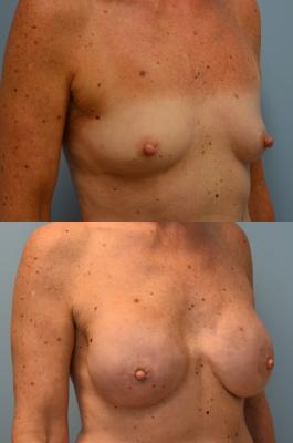 BREAST RECONSTRUCTION WITH TISSUE EXPANDERS 