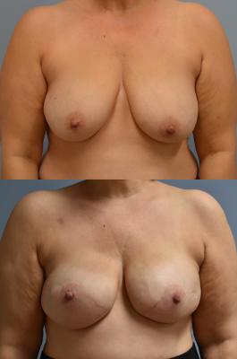 BREAST RECONSTRUCTION WITH TISSUE EXPANDERS AND ADM GRAFT