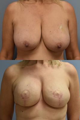 BREAST RECONSTRUCTION WITH TISSUE EXPANDER AND ADM GRAFT