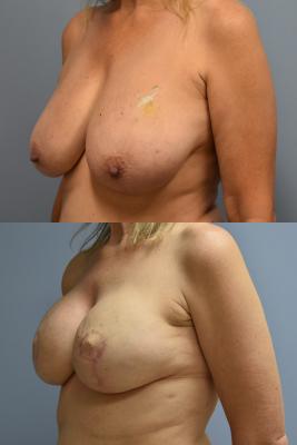 BREAST RECONSTRUCTION WITH TISSUE EXPANDER AND ADM GRAFT
