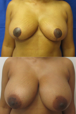 breast reduction before & after