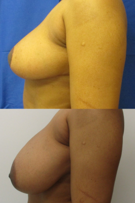 breast reduction before & after