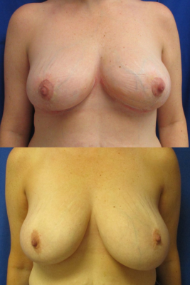 breast reduction before & after