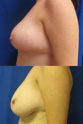 breast reduction before & after