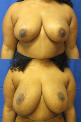 breast reduction before & after