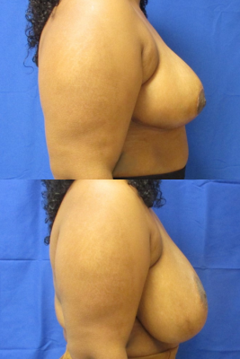 breast reduction before & after