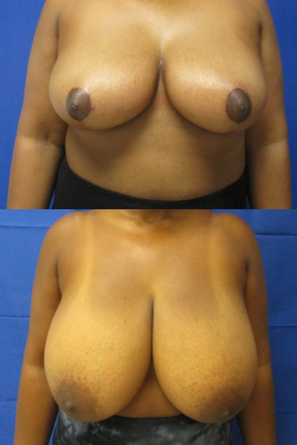 breast reduction before & after