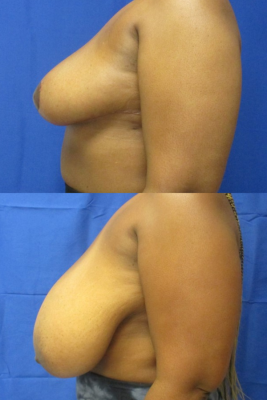 breast reduction before & after