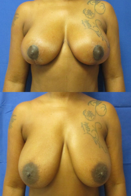 breast reduction before & after