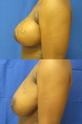 breast reduction before & after