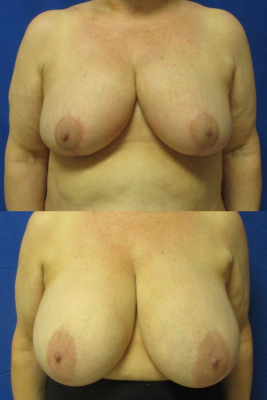 breast reduction before & after