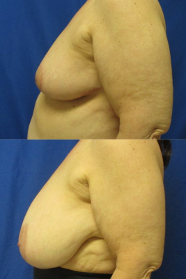 breast reduction before & after