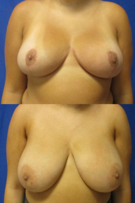 breast reduction before & after