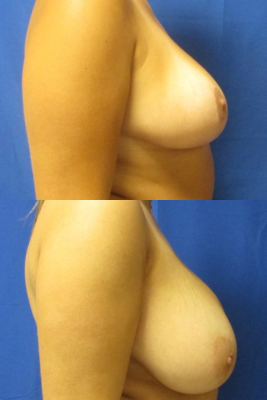 breast reduction before & after