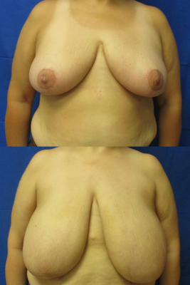 breast reduction before & after