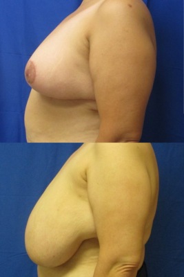 breast reduction before & after