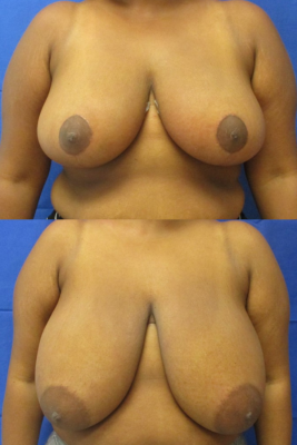 breast reduction before & after