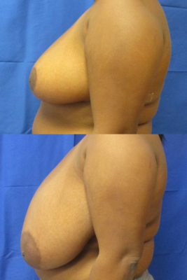 breast reduction before & after