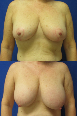 breast reduction before & after