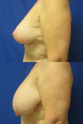 breast reduction before & after