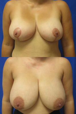 breast reduction before & after