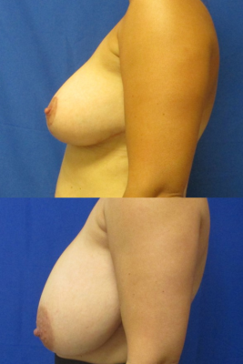 breast reduction before & after