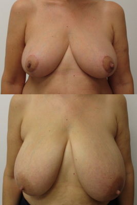 breast reduction before & after