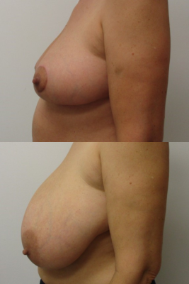 breast reduction before & after