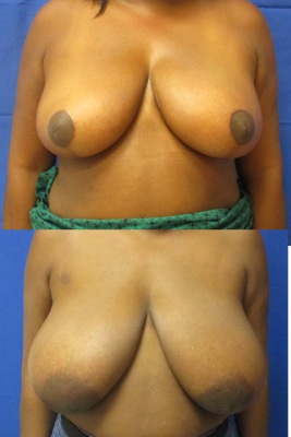 breast reduction before & after