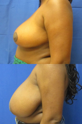 breast reduction before & after