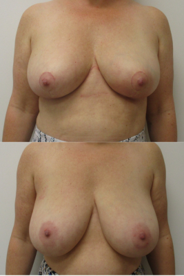 breast reduction before & after