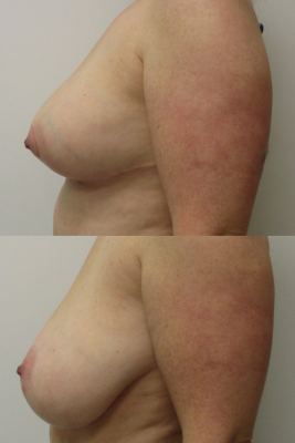 breast reduction before & after