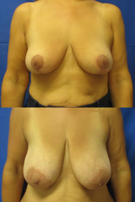 breast reduction before & after