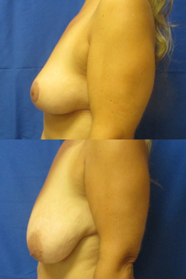 breast reduction before & after