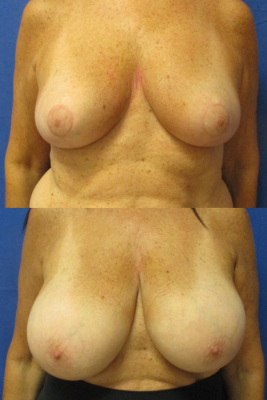 breast reduction before & after