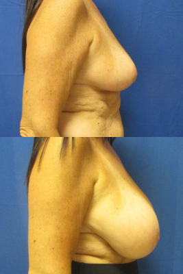 breast reduction before & after