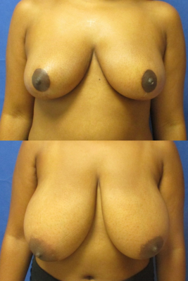 breast reduction before & after