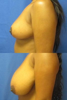 breast reduction before & after