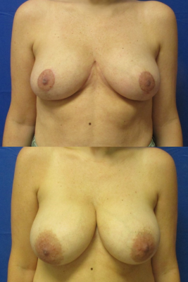 breast reduction before & after