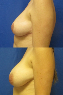 breast reduction before & after