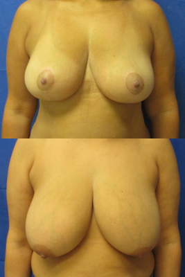 breast reduction before & after