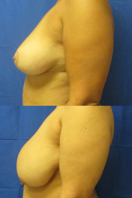 breast reduction before & after