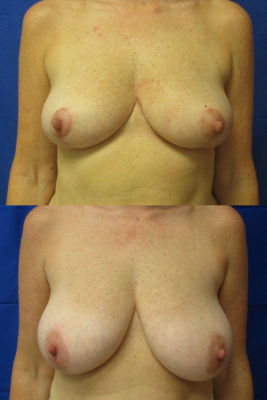 breast reduction before & after