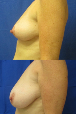 breast reduction before & after