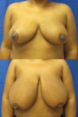 breast reduction before & after