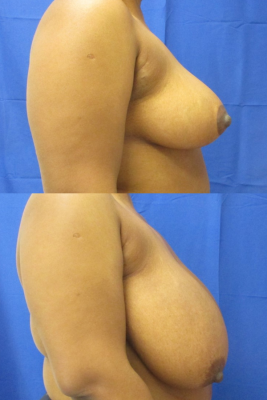 breast reduction before & after