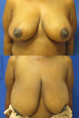breast reduction before & after