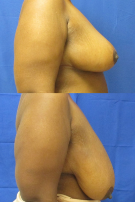 breast reduction before & after